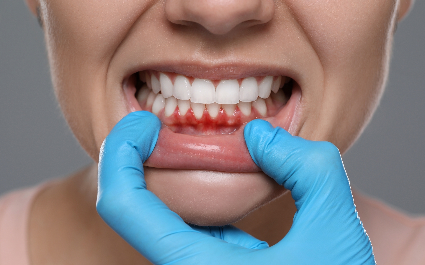 Gum Disease Treatment