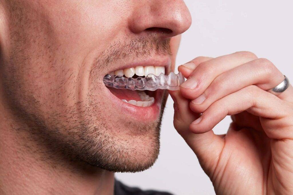 Clear Aligners Dentistry