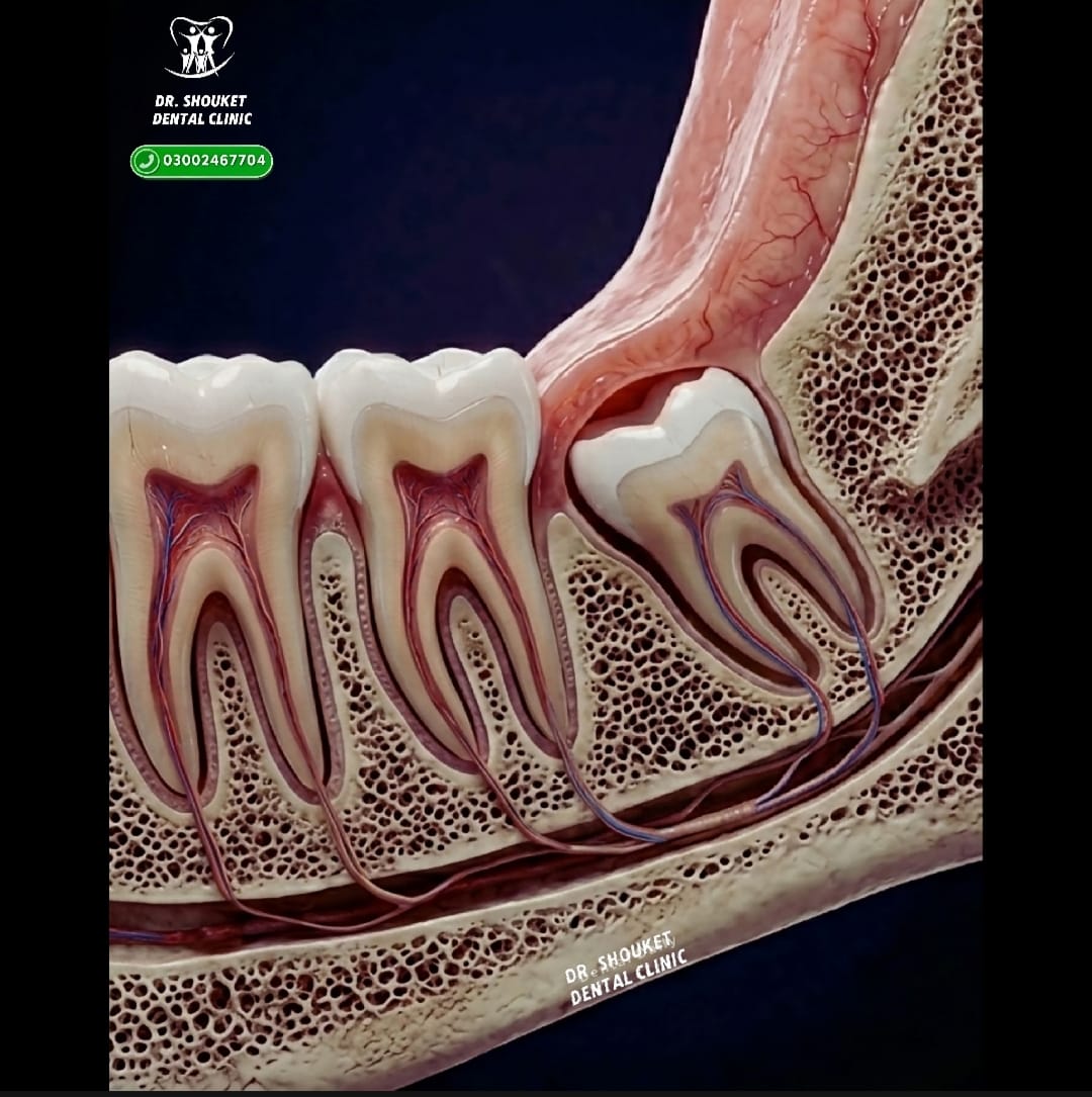 Wisdom Tooth Removal